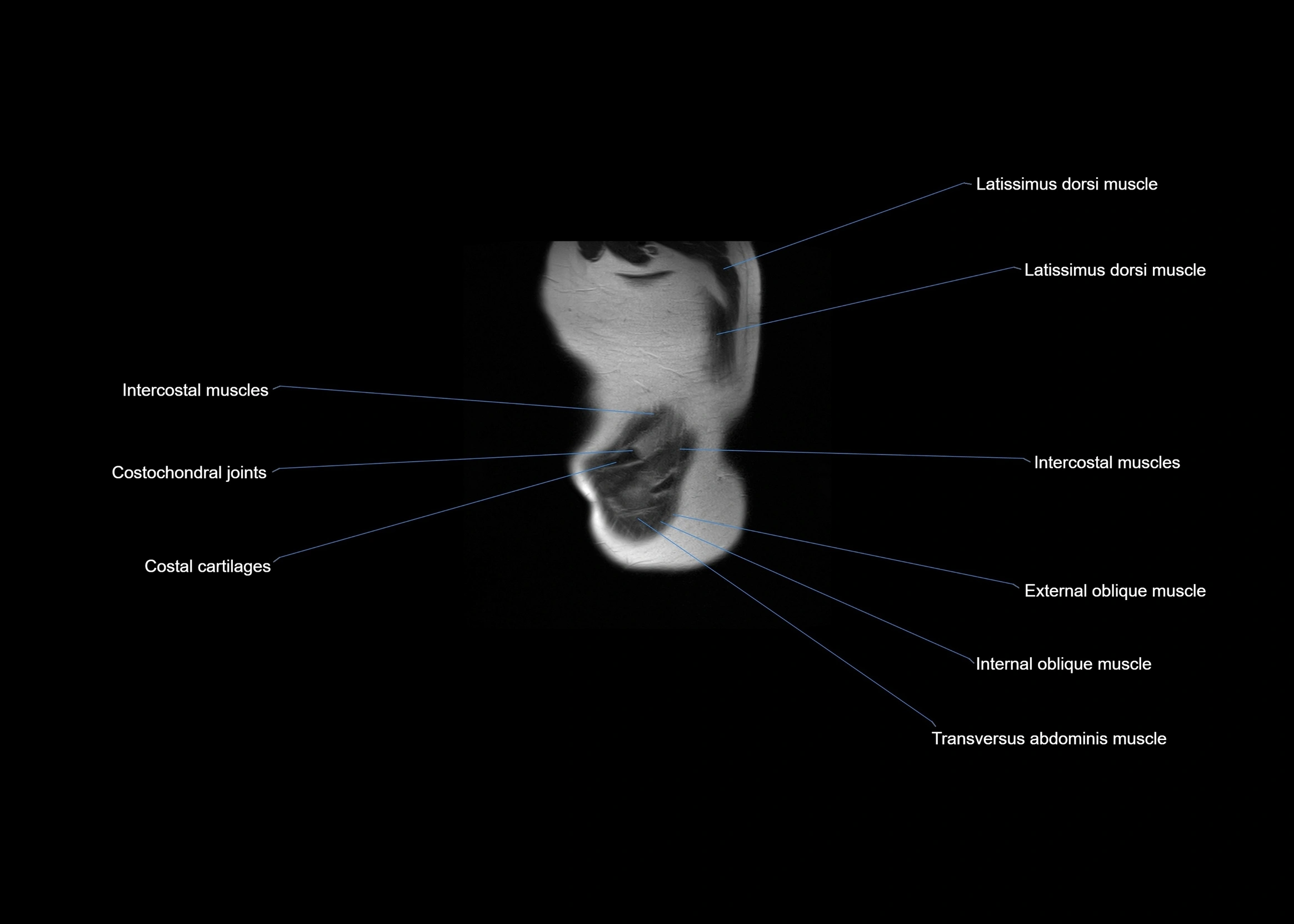 MRI abdomen sagittal cross sectional anatomy  radiology  image-img-00001-00067.webp